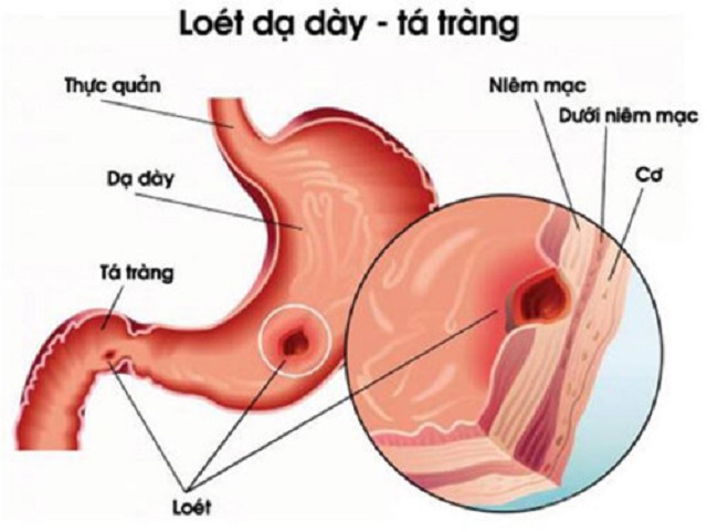 Bệnh viêm loét dạ dày có nguy hiểm không