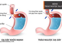 Trào ngược dạ dày thực quản có thể dẫn đến ung thư thực quản