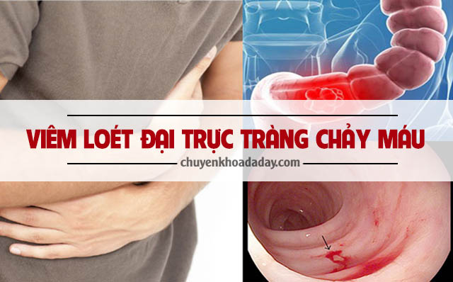 viêm loét đại trực tràng chảy máu