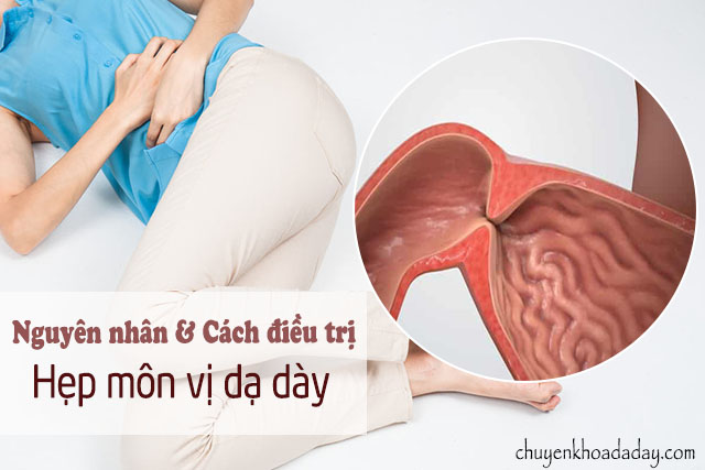 hẹp môn vị dạ dày