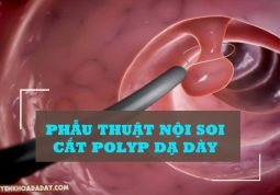 Phẫu thuật nội soi cắt Polyp dạ dày