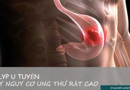 Polyp u tuyến gây nguy cơ ung thư dạ dày rất cao