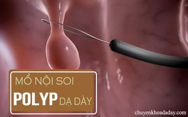 mổ nội soi polyp dạ dày