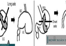 Xoắn dạ dày gây ảnh hưởng nghiêm trọng đến sức khỏe người bệnh