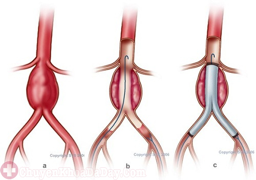 Đau bụng bên trái dưới sườn không nên chủ quan