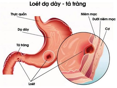 Đau thượng vị ợ hơi