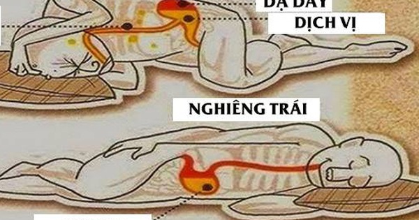 Trào ngược dạ dày nằm nghiêng trái hay phải