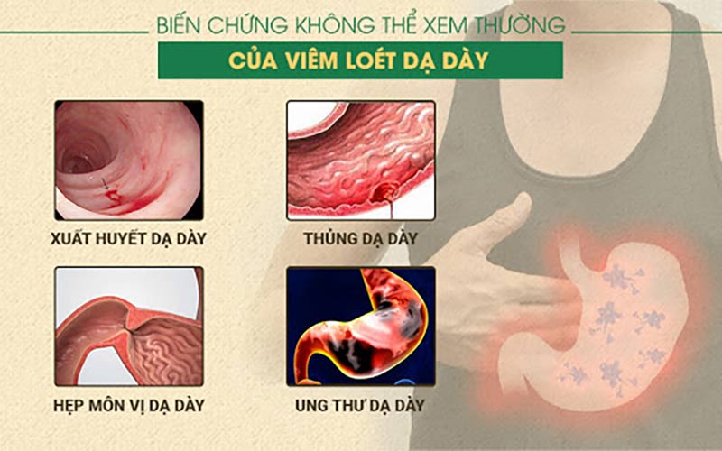 Viêm loét dạ dày có thể gây nhiều biến chứng nguy hiểm