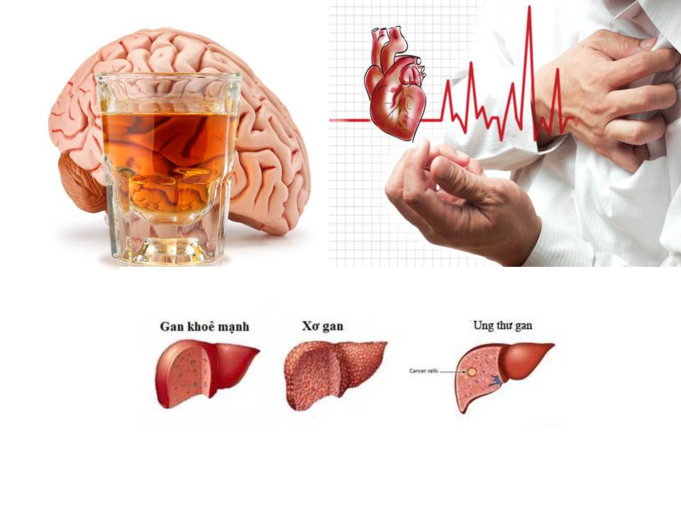 Viên giải rượu No Say chống say rượu bia và giải rượu cực kỳ hiệu quả