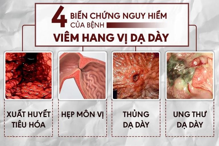 Các biến chứng nguy hiểm của bệnh viêm hang vị